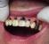 Изплакване на зъбите с лайка Възможно ли е да изплакнете устата си с прясна лайка?