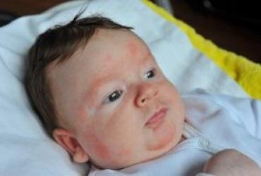 Was verursacht Nesselsucht bei Babys?